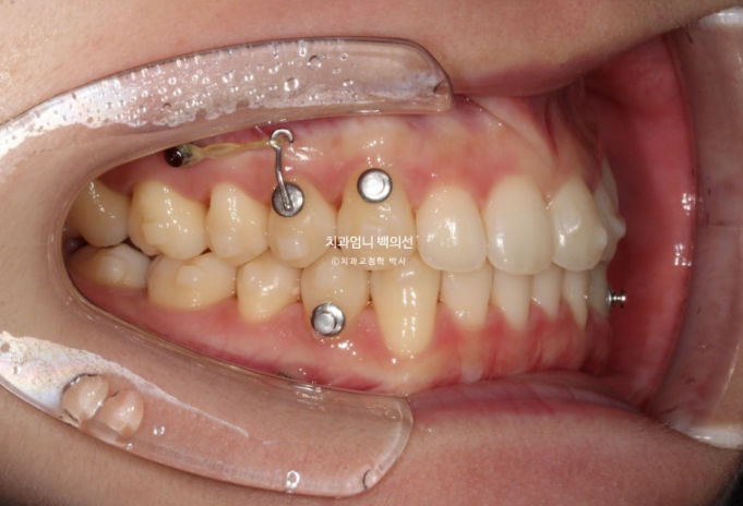 인비절라인 교정 비발치 비대칭 덧니 중심선 선천적 결손치 교정? 관련 이미지 9