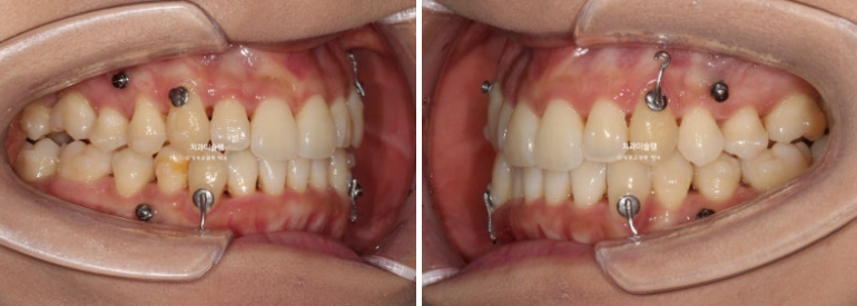 인비절라인 비발치 제2대구치 발치 사랑니 대체 교정 심한 덧니 교정 치료 관련 이미지 12