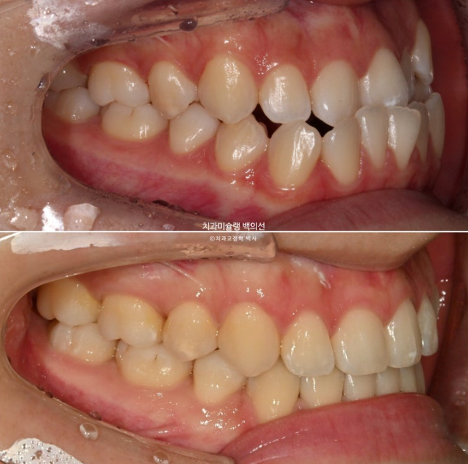 비수술 주걱턱 비대칭 발치 교정 결손치 반대교합 클리피씨 치료기간 1년 11개월 관련 이미지 14