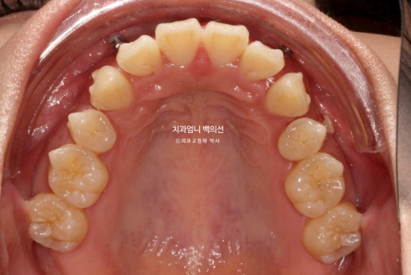 돌출입 교정 인비절라인 발치 교정 후기 관련 이미지 11