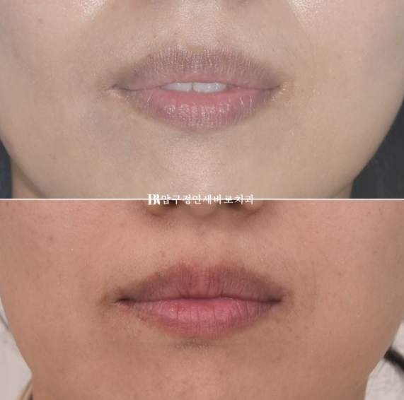 40대 재교정 가능할까요? 비발치 돌출입 교정 호두턱 팔자주름 후기 관련 이미지 9