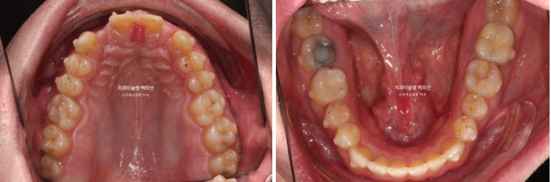 앞니 선천적 결손 인비절라인 임플란트 과개교합 치료 기간 관련 이미지 10