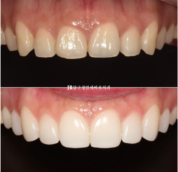 Before and After Non-Prep Veneers: Improving Gaps Between the Front Teeth and the Smile Line Together image 9