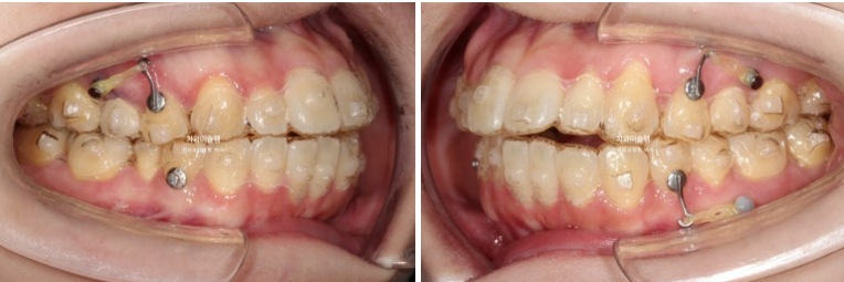 비발치 인비절라인 교정 편측 개방교합 가위교합 돌출 재교정 관련 이미지 9