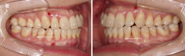 Is Invisalign Treatment Possible After Double-Jaw Surgery? A Real One-Year Case of Surgery-First Orthodontic Treatment image 7
