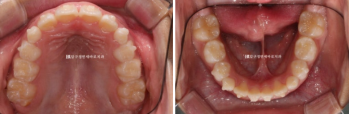 무턱교정 어린이 투명교정 인비절라인 퍼스트 교정 후기 관련 이미지 7