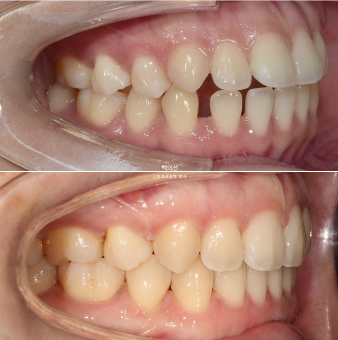돌출입 교정 인비절라인 발치 교정 개방교합 치료 후기 관련 이미지 23