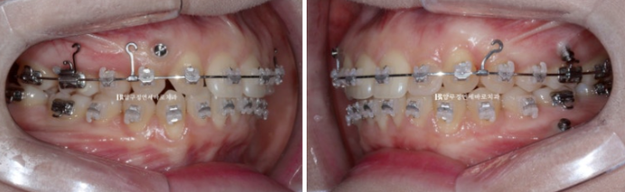 Actual Case of Treating Congenitally Missing and Peg-Shaped Teeth Without Implants image 8