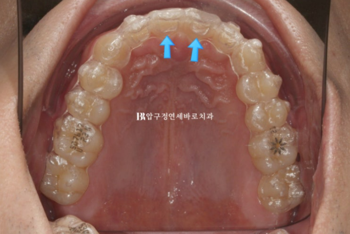 인비절라인 재제작 없이 끝낸 벌어진 치아 교정 케이스 관련 이미지 4