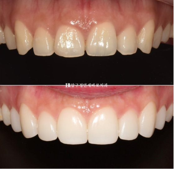 Non-Prep Veneer Review | A Case Naturally Improving Gaps Between the Front Teeth and the Smile Line image 9