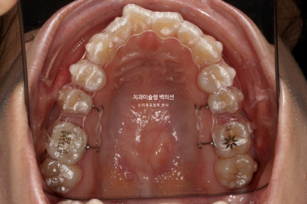 인비절라인 돌출입 발치교정 임플란트 없이 사랑니 대체 관련 이미지 9
