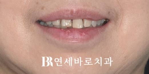 50대 60대 중년 치아 벌어짐 단기 교정 해결하기 관련 이미지 1