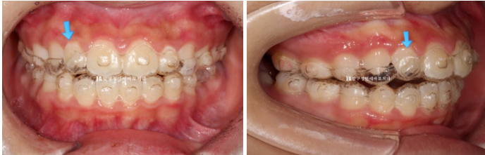 A Child’s Protruding Teeth Correction Review: Difficulty Closing the Lips image 10