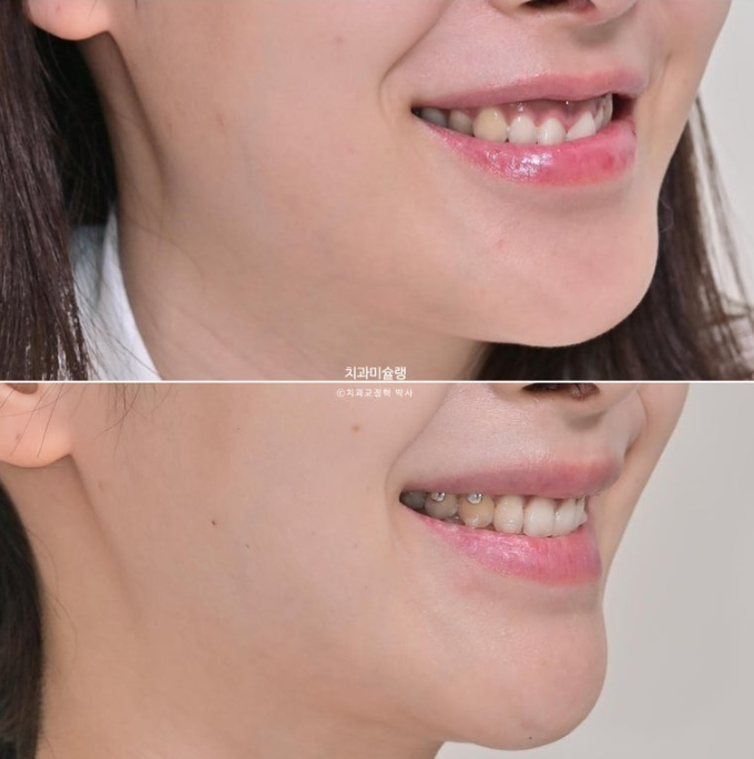 선수술 양악수술 비대칭 주걱턱 잇몸미소 치료 인비절라인 라이트 관련 이미지 1