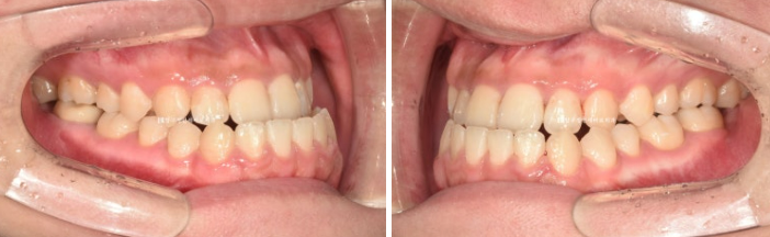 양악수술 교정 인비절라인 주걱턱 교정 치료 후기 관련 이미지 3