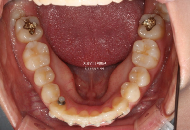 앞니 부분 교정 급속 교정 토끼이빨 MTA 미니튜브 치간삭제 치료기간 9개월 관련 이미지 8
