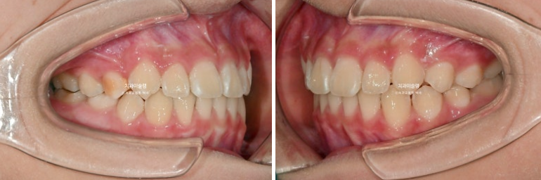 어린이 돌출입 교정 무턱 투명교정 인비절라인 퍼스트 관련 이미지 16