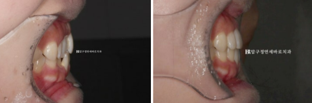 앞니부분교정 기간? MTA 미니튜브 교정 반대교합 교정 관련 이미지 8