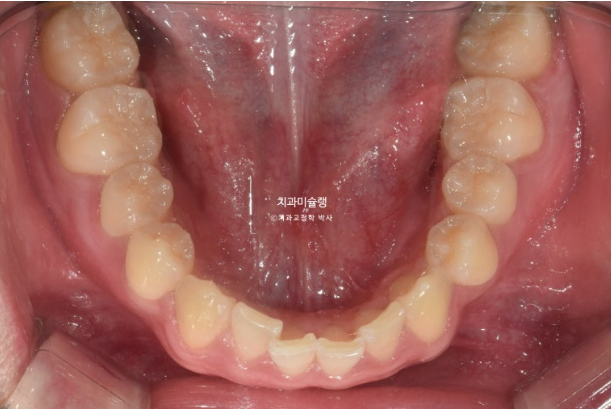 비대칭 비발치 거미스마일 잇몸미소 중심선 가위교합치료 무삭제 라미네이트 관련 이미지 7