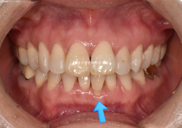 50대 치아교정 인비절라인 라이트 앞니교정 치료 후기 관련 이미지 3