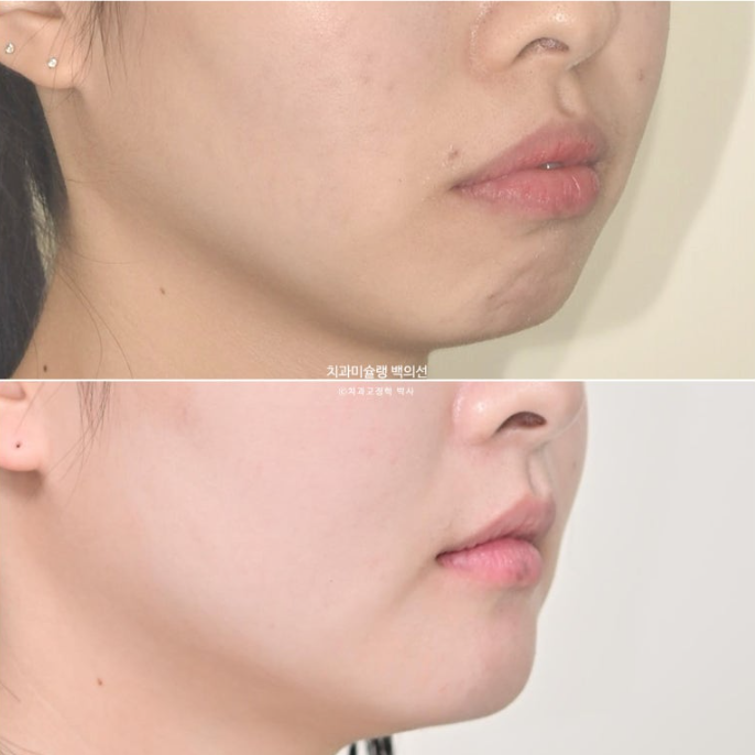 돌출입 인비절라인 발치교정 거미스마일 잇몸미소 잇몸돌출 입술부전증 무턱 재교정 관련 이미지 21