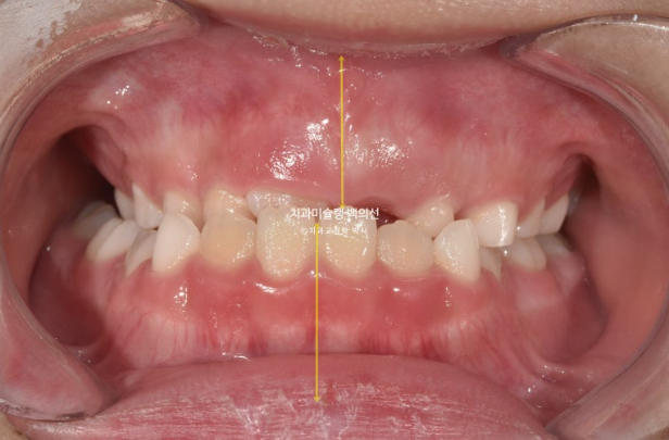 어린이 비대칭 반대교합 주걱턱 인비절라인 퍼스트 프리올소 성장 교정 관련 이미지 4