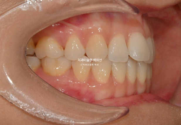 인비절라인 익스프레스 재교정 블랙트라이앵글 치간 삭제 치료기간 6개월 재제작 1회 관련 이미지 4