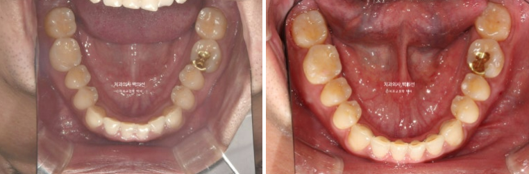 30대 주걱턱 비수술 비발치 교정 후기 관련 이미지 11