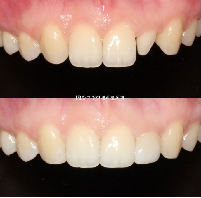 Actual Case of Treating Congenitally Missing and Peg-Shaped Teeth Without Implants image 11