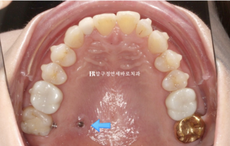40대 인비절라인 라이트 가위교합, 과개교합까지 10개월 교정 증례 관련 이미지 7