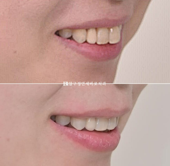 Invisalign Lite for Orthodontic Treatment in Your 40s: Crossbite and Protrusive Mouth Correction image 19