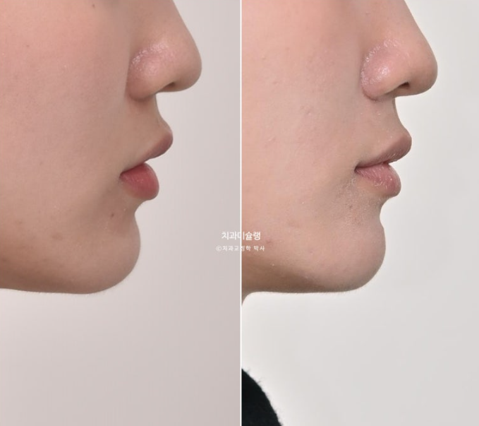 인비절라인 비발치 토끼이빨 교정 덧니 교정 치료기간 1년 8개월 관련 이미지 17