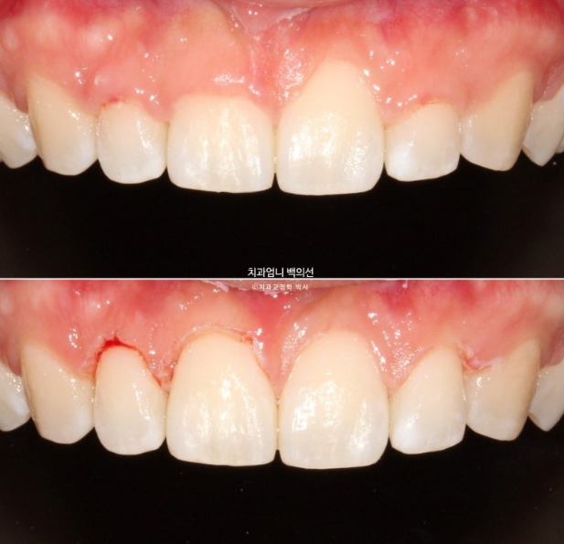 거미스마일 과개교합 교정 잇몸돌출 잇몸 비대칭 관련 이미지 9