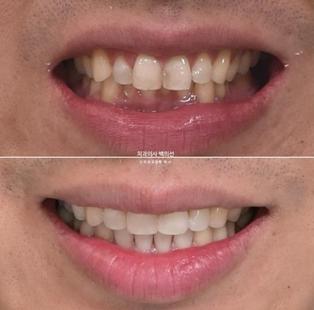 40대 인비절라인 라이트 과개교합 과잉치 덧니 교정 임플란트 보철 교정 후기 관련 이미지 2