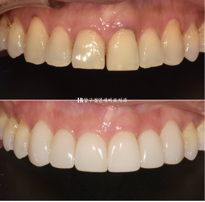 How to Avoid Regretting No-Prep Laminate Veneers: The Fitting Process Revealed image 7