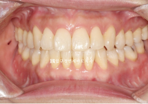 Is Invisalign Treatment Possible After Double-Jaw Surgery? A Real One-Year Case of Surgery-First Orthodontic Treatment image 10