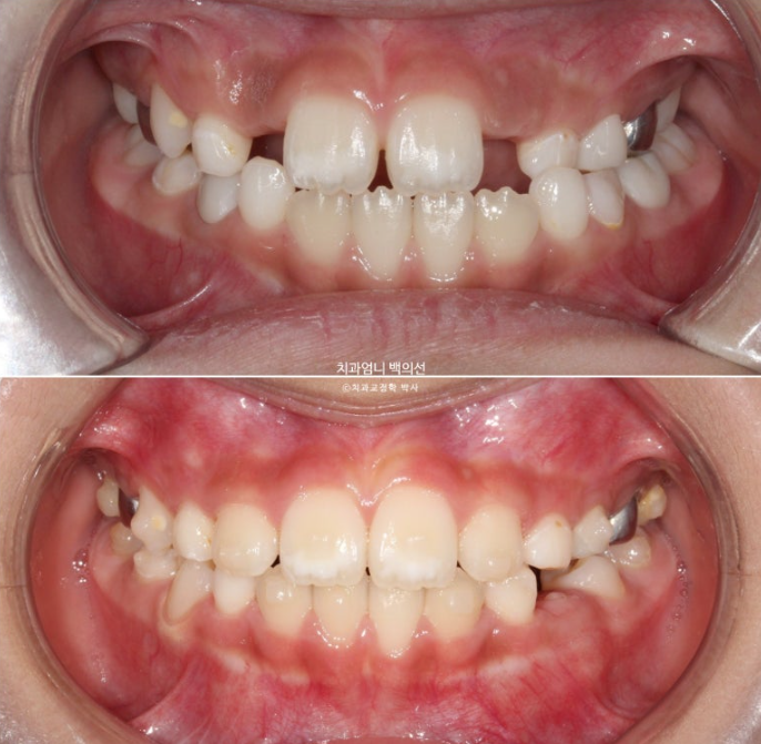 어린이 교정 인비절라인 퍼스트 비대칭 반대교합 어린이 성장 교정 관련 이미지 17