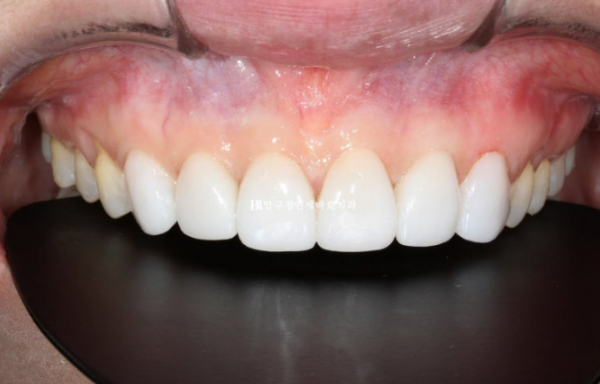 Can Gaps Between the Front Teeth Be Treated with No-Prep Veneers Alone? A Real Case Completed with Gelami After Invisalign Lite image 18
