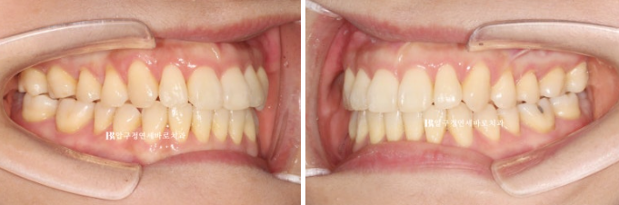양악수술 선수술 교정 후기 인비절라인 교정 관련 이미지 11