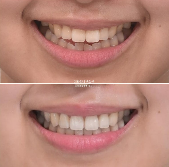 인비절라인 개방교합 교정 어금니 함입 교정 비베라? 관련 이미지 14