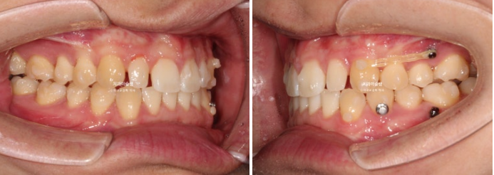 비대칭 비발치 거미스마일 잇몸미소 중심선 가위교합치료 무삭제 라미네이트 관련 이미지 11