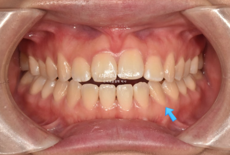 앞니 단기 부분교정 재교정 개방교합 교정 후기 관련 이미지 2