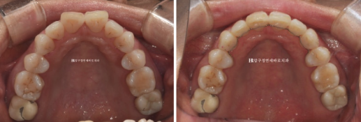 40대 50대 잇몸 약한데 교정해도 될까? 잇몸퇴축이 있는 앞니 부분교정 증례 관련 이미지 11