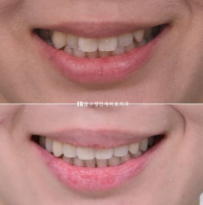 Invisalign Lite Treatment for Crossbite, Rabbit Teeth, and Protruding Front Teeth Correction image 11