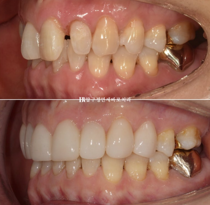 Can It Be Done in Your 50s? Real Results from Limited Front Teeth Orthodontics + No-Prep Laminate Veneers Revealed image 15