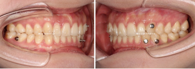 옥니 교정 인비절라인 라이트 옹니 덧니 치료기간 ? 관련 이미지 7