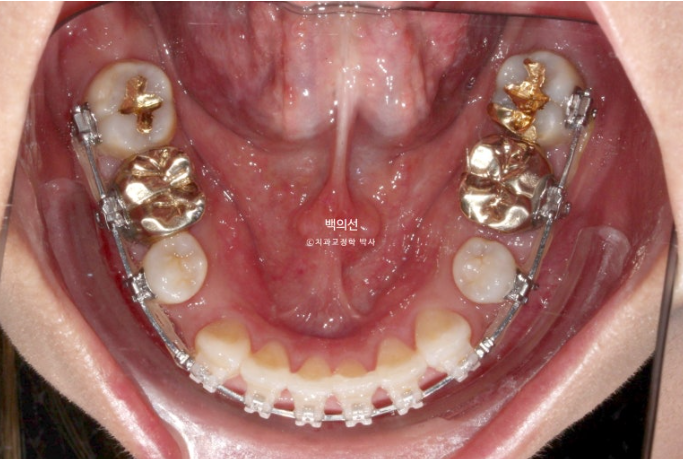 거미스마일 교정 돌출입 발치교정 입술부전 호두턱 치료기간 2년반 관련 이미지 13