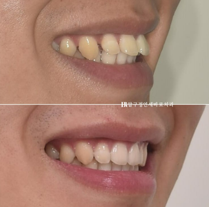 Can Invisalign Fix a Gap Between the Front Teeth? ๐ฎ A Real 9-Month Case Finished Without Remaking Aligners image 12