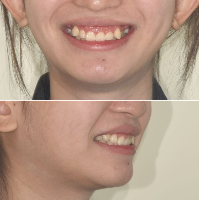 잇몸미소 거미스마일 치료 옥니 교정 잇몸성형 후기 관련 이미지 3