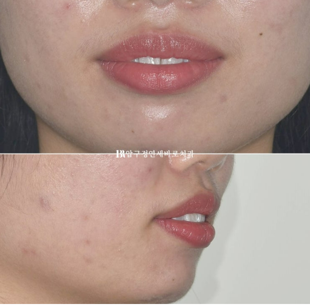 How Do the Buccal Corridors and Smile Line Change After Extraction Treatment for Protruding Teeth?|An Orthodontic Case That Also Improved Lip Incompetence image 4